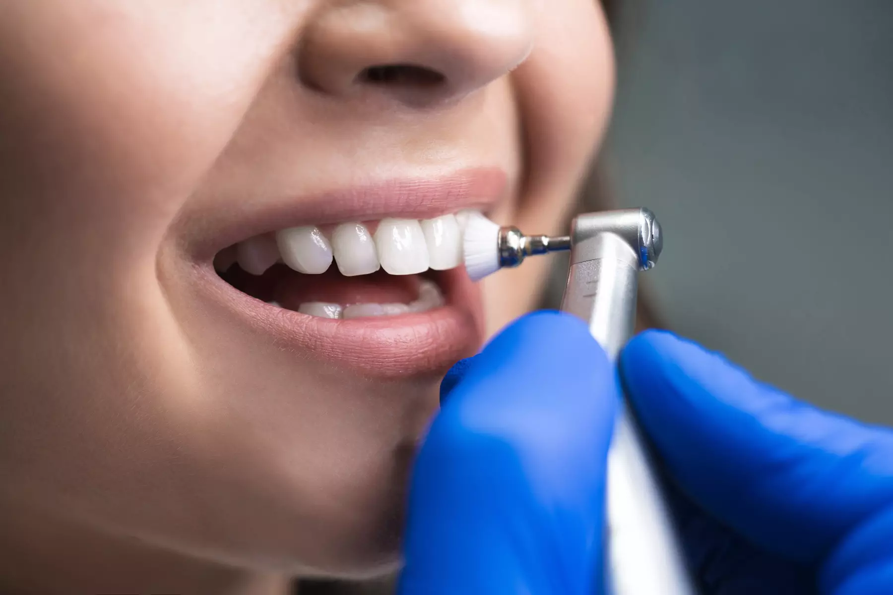 Get a Dental Exam, Xray, Intraoral Scanning & Cleaning