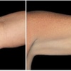 Image 1: Fat / Cellulite Reduction - Non-Branded at Dpz parlour