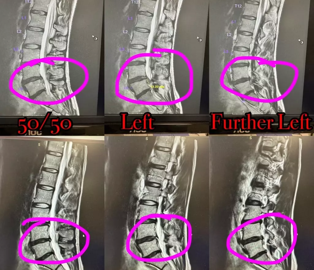 Up to 82% Off on Spinal Decompression or Medical Laser Treatment at Lexington Spinal Care, LLC - Second Medium