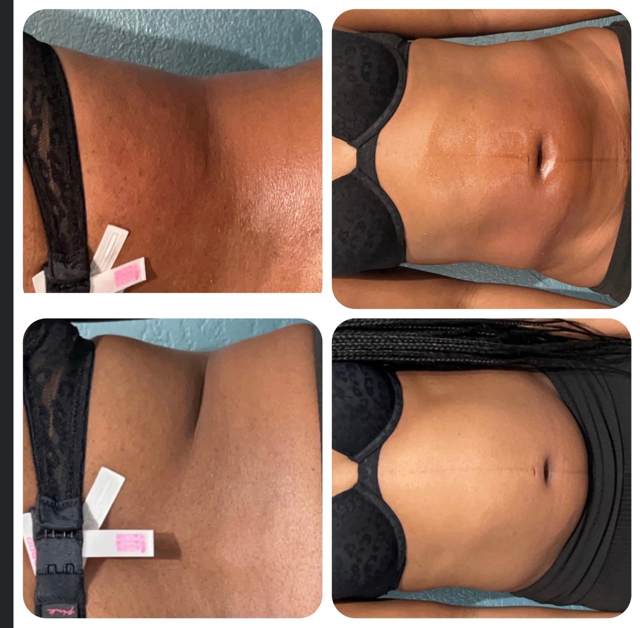 Body Sculpting Sessions for Abs, Hips, and Thighs