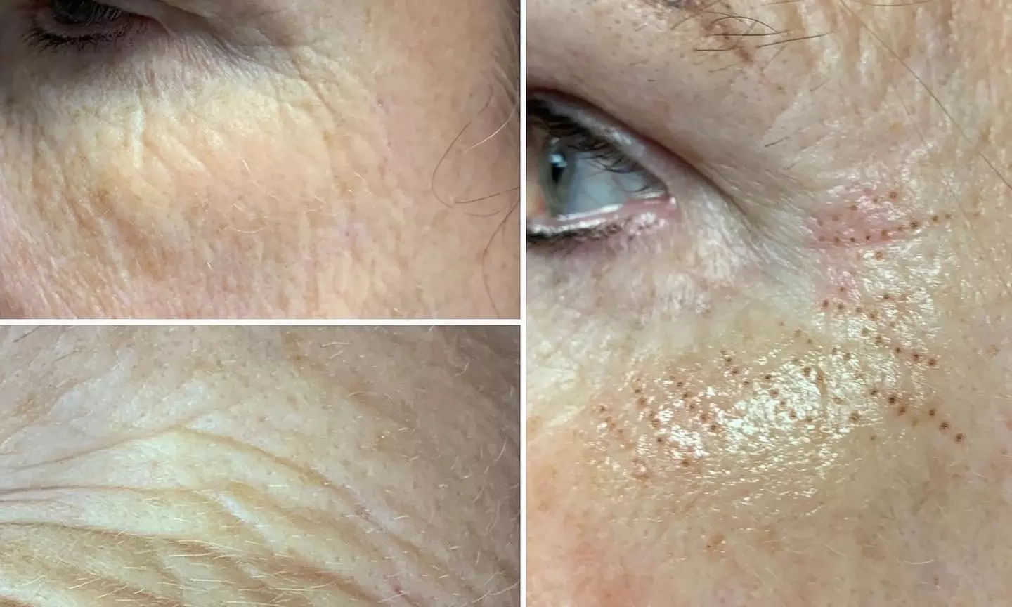 Up to 45% Off on Facelift - Non-Surgical at Bella Joli Esthetique - Primary Image