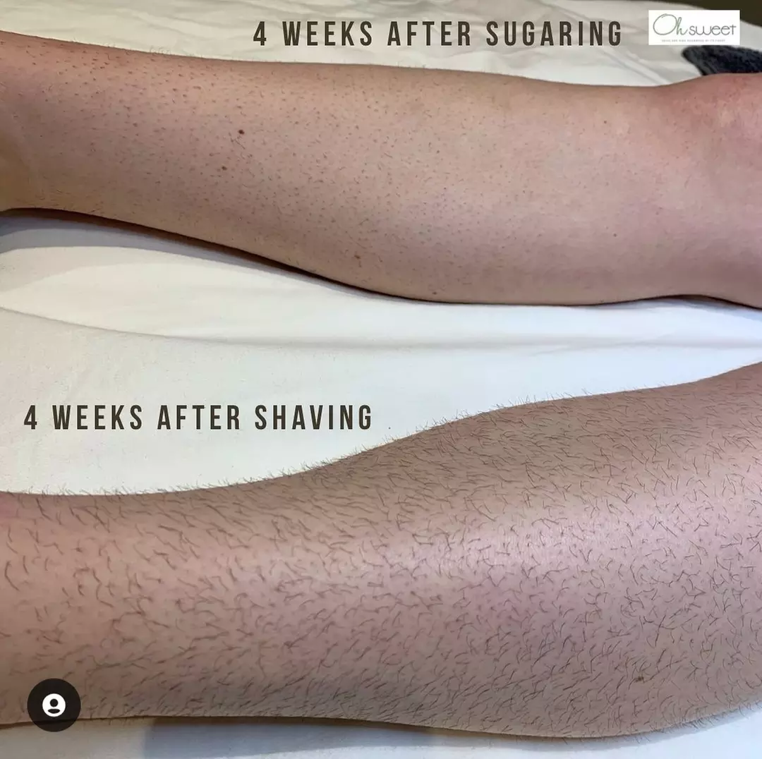 Experience smooth skin with sugaring and microneedling treatments at Skin Palace OC, offering up to 64% off - Second Medium