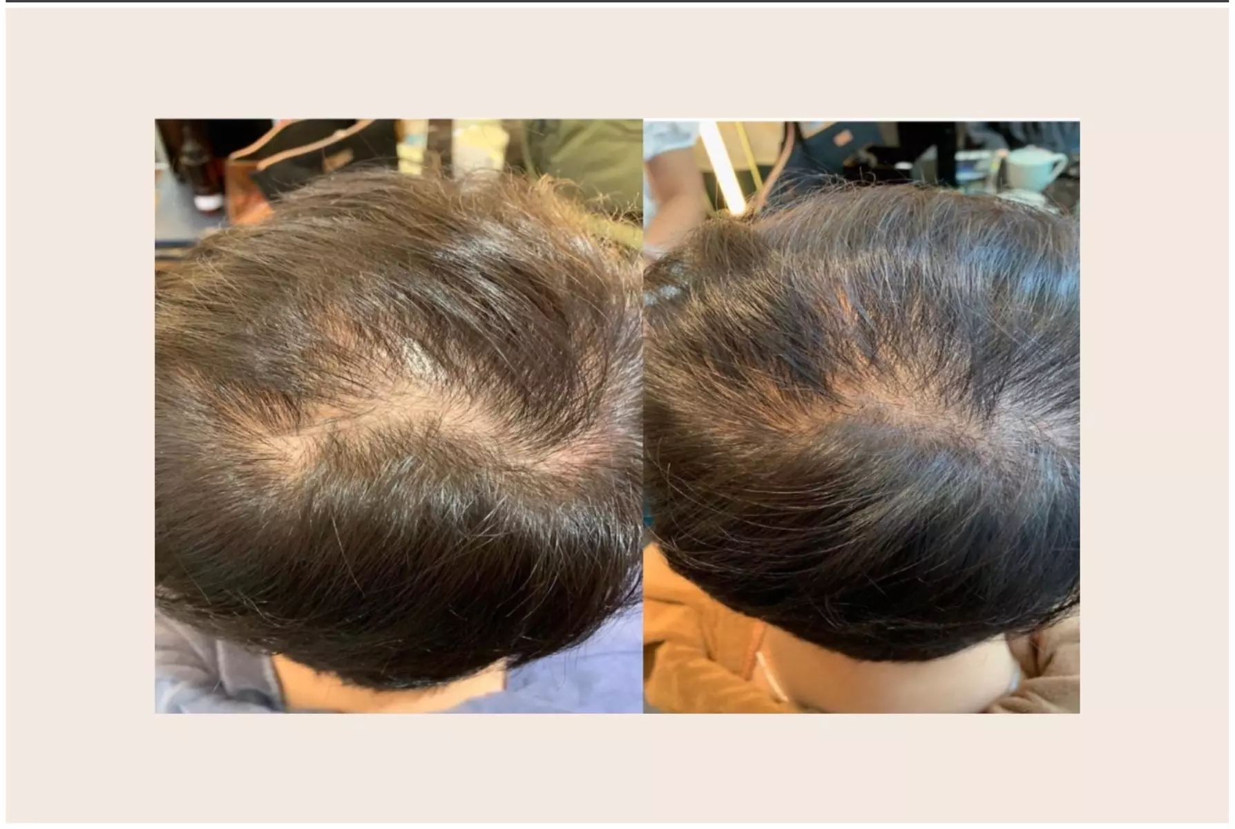 Discover PURE HAIR SPA's scalp treatments for hair loss and dandruff with up to 50% off. Experience personalized care. - Primary Image