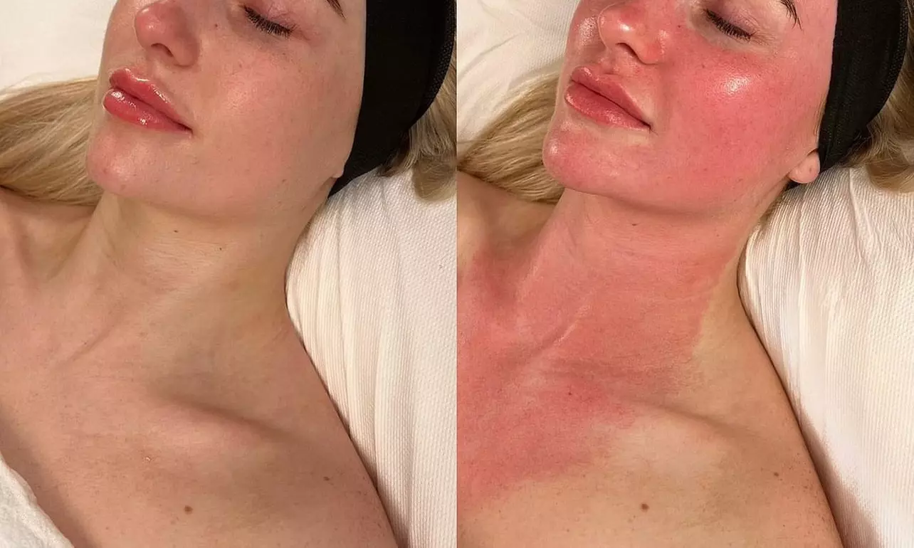 PRP with Micro-needling Facial, PRP for Hair Growth, or PRP for Under-Eyes (Up to 40% Off) - Second Medium