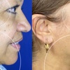 Image 2: One Fibroblast Plasma Session on Choice of Treatment Areas