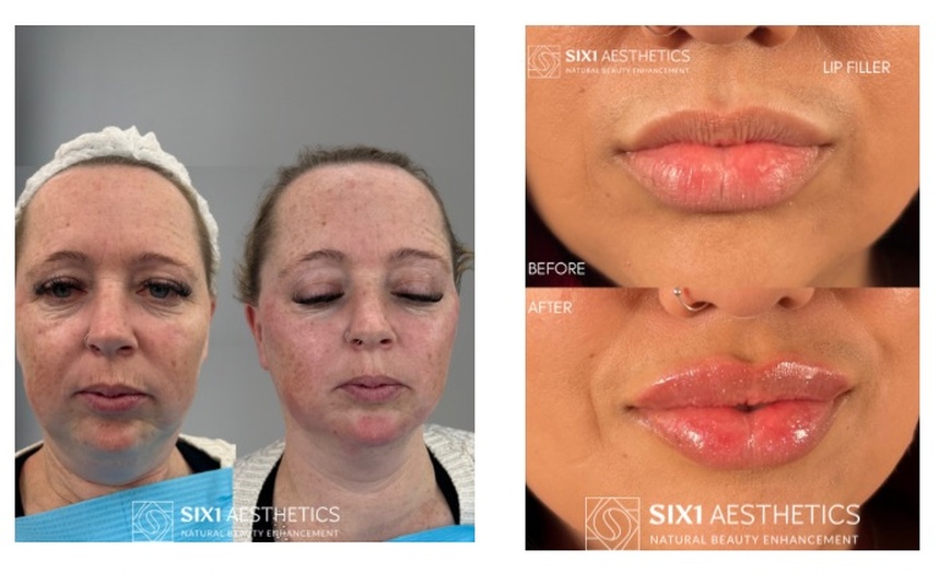 Image 4: Revitalize with 1ml, 2ml, or 3ml Dermal Fillers for Cheek, Jaw or Chin