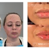 Image 4: Revitalize with 1ml, 2ml, or 3ml Dermal Fillers for Cheek, Jaw or Chin