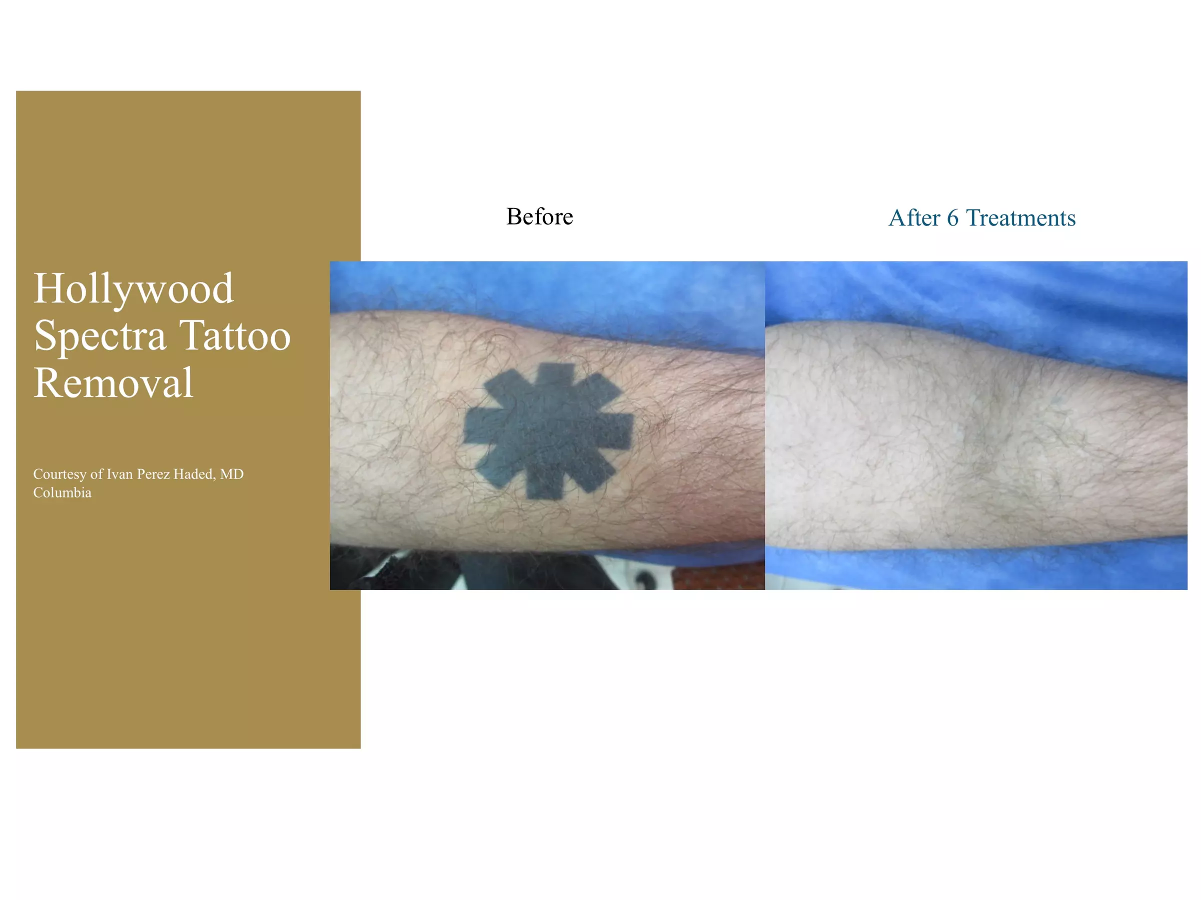 Up to 60% Off on Tattoo - Temporary at Surry Hills Laser & Cosmetic