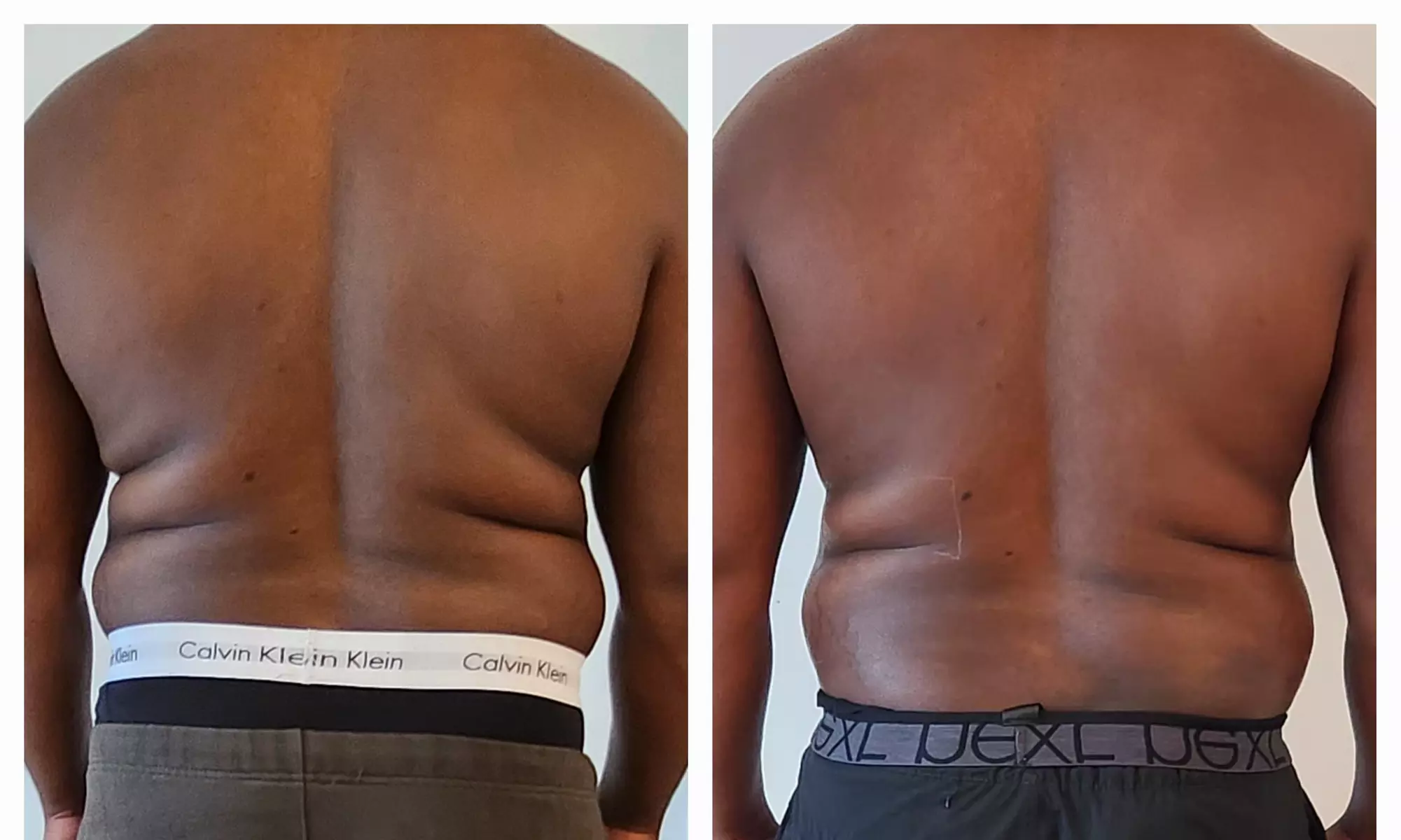 Up to 50% Off on Fat / Cellulite Reduction - Non-Branded at Noire Aesthetics