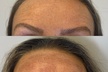 Up to 50% Off on Facelift - Non-Surgical at About Face Esthetics - Second Medium