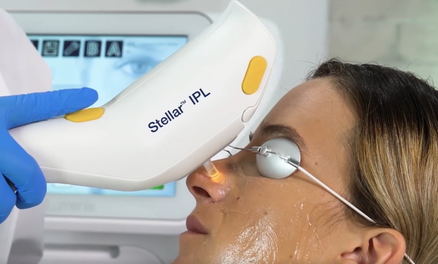 Image 2: Revitalize Your Skin: 1 or 3 IPL Photofacials Sessions at Bye 2 Hair
