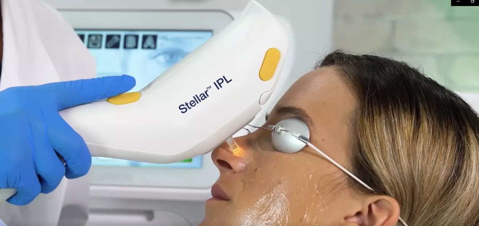 Revitalize Your Skin: 1 or 3 IPL Photofacials Sessions at Bye 2 Hair
