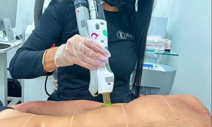 Smooth Skin with Six Laser Hair-Removal Sessions