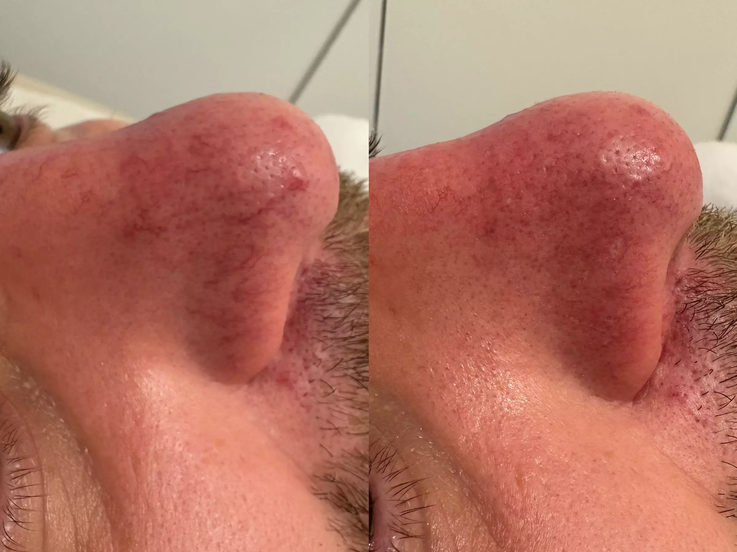 Spider Vein Laser Treatments for Nose, Face & Small Areas