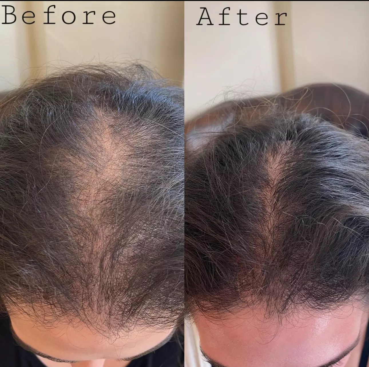 PRP / Platelet Rich Plasma / Vampire at Dr S Aesthetics