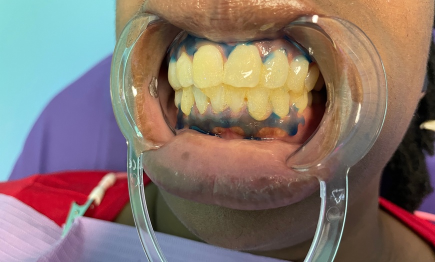 Image 1: Teeth Whitening - In-Office at Spoiled Goddess & King Detox