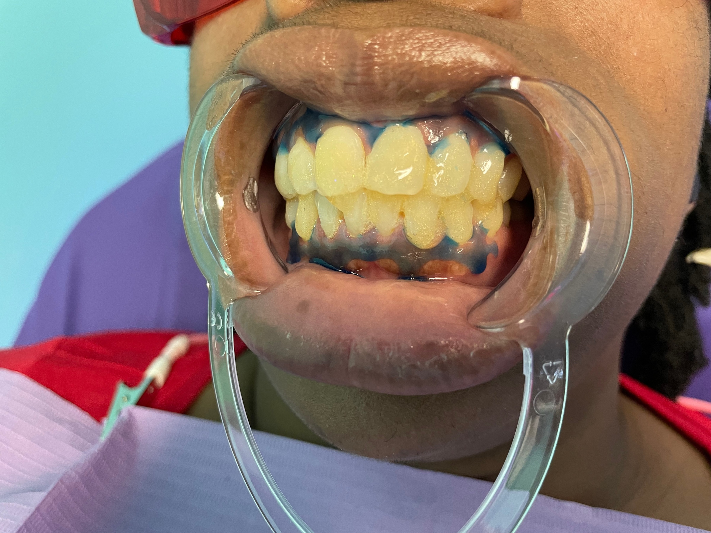 Up to 35% Off on Teeth Whitening - In-Office - Non-Branded at Spoiled Goddess & King Detox - Primary Image