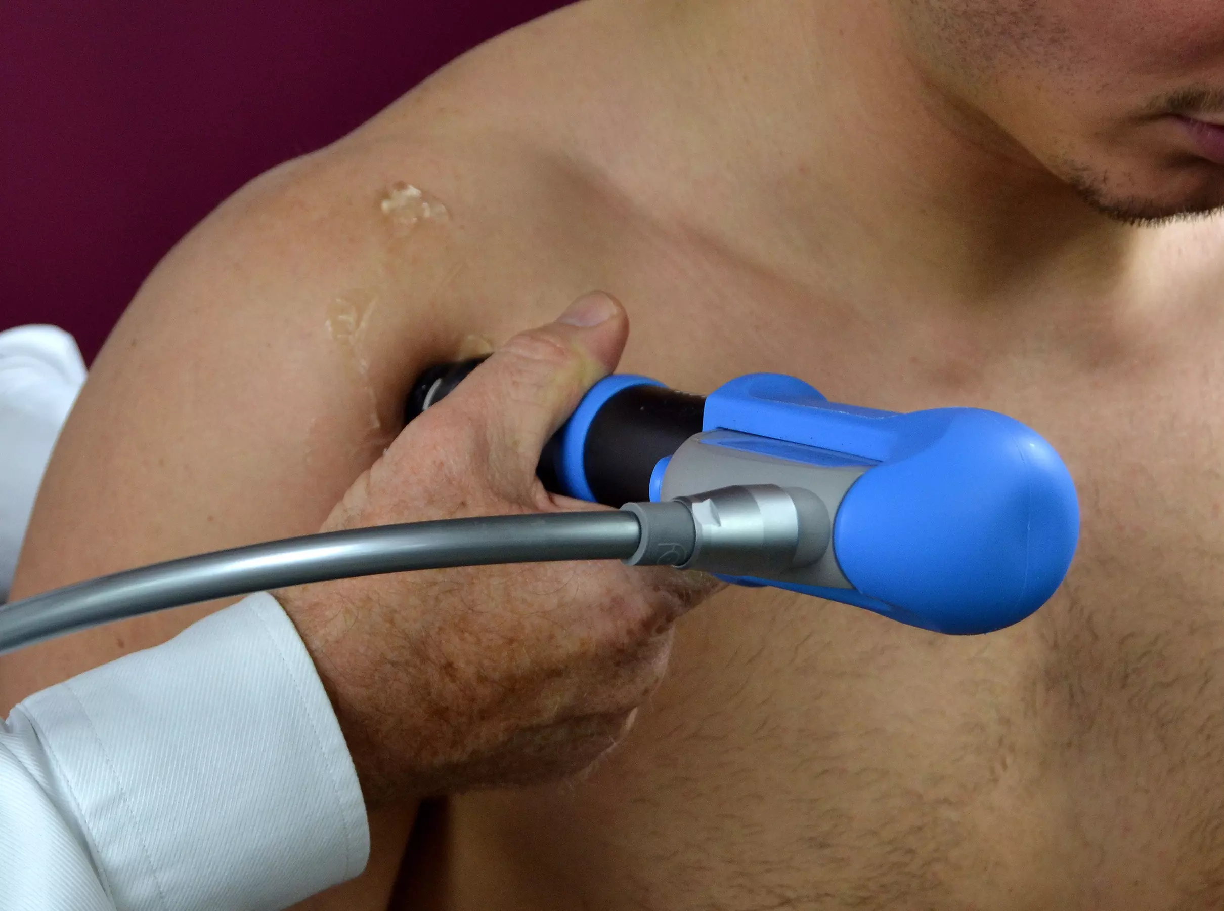 Up to 10% Off Shockwave Therapy at KC Wellness & Physiotherapy – Target Chronic Pain & Muscle Recovery - Primary Image