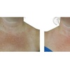 Image 5: Laser Skin Rejuvenation for Face, Neck, or Hands