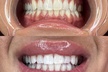 Up to 15% Off on Teeth Whitening at Pearl Glow Smiles - Second Medium