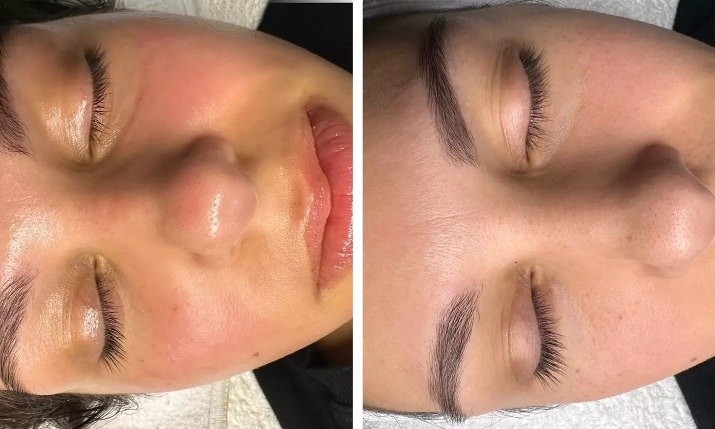 Up to 61% Off on Chemical Peel at Flawless Beauty by Devon - Second Medium