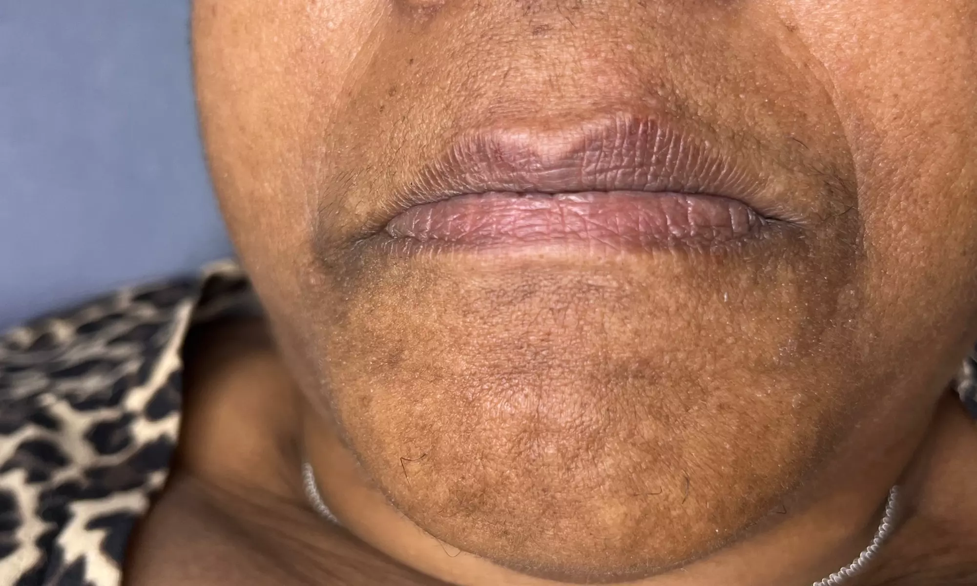 Up to 50% Off on Injection - Hyaluronic Acid at House of Beauty ByJ - Second Medium