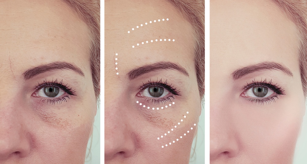 One or Four 45 Min Jet Plasma Skin Tightening Treatment