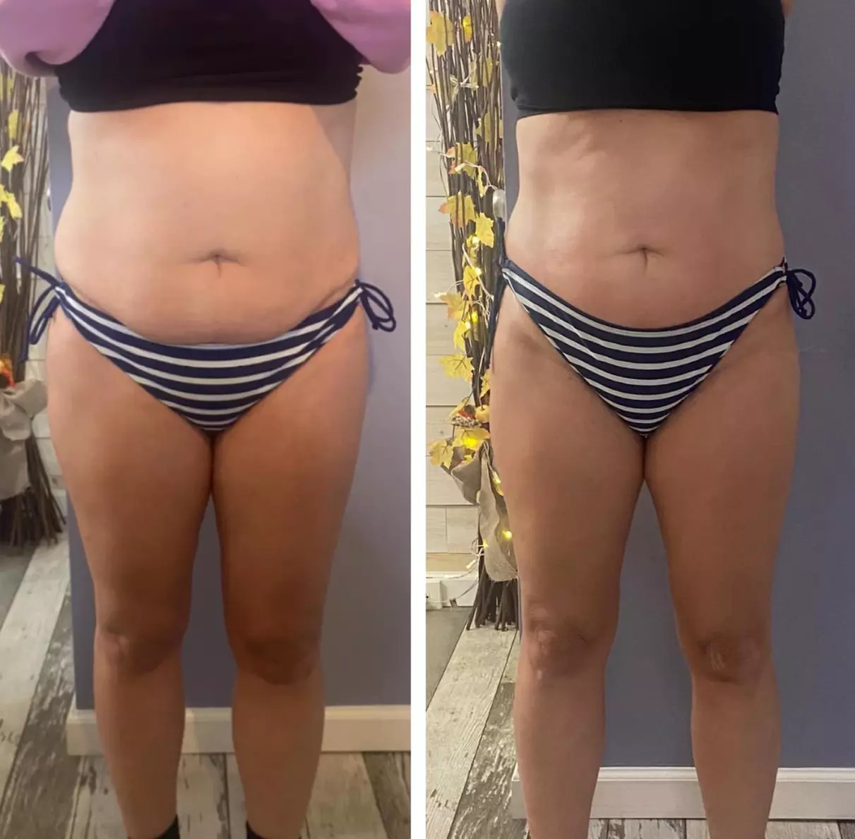 Up to 80% Off on Ultrasonic Fat Reduction at Rejuvenation Esthetics & Day Spa - Primary Image