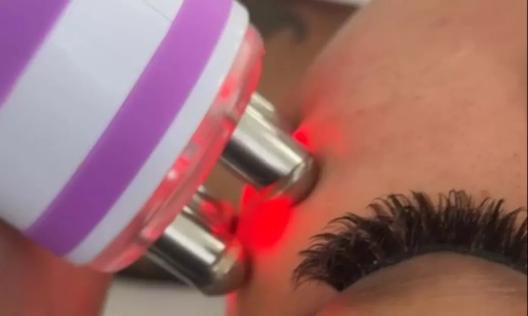 Up to 30% Off on Radio Frequency Skin Tightening at WickedTight - Primary Image