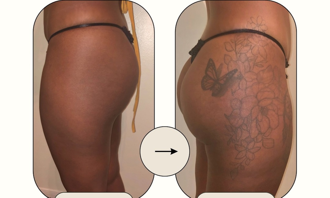 Experience Vacuum Brazilian Butt Lift in 30 or 45 Minutes