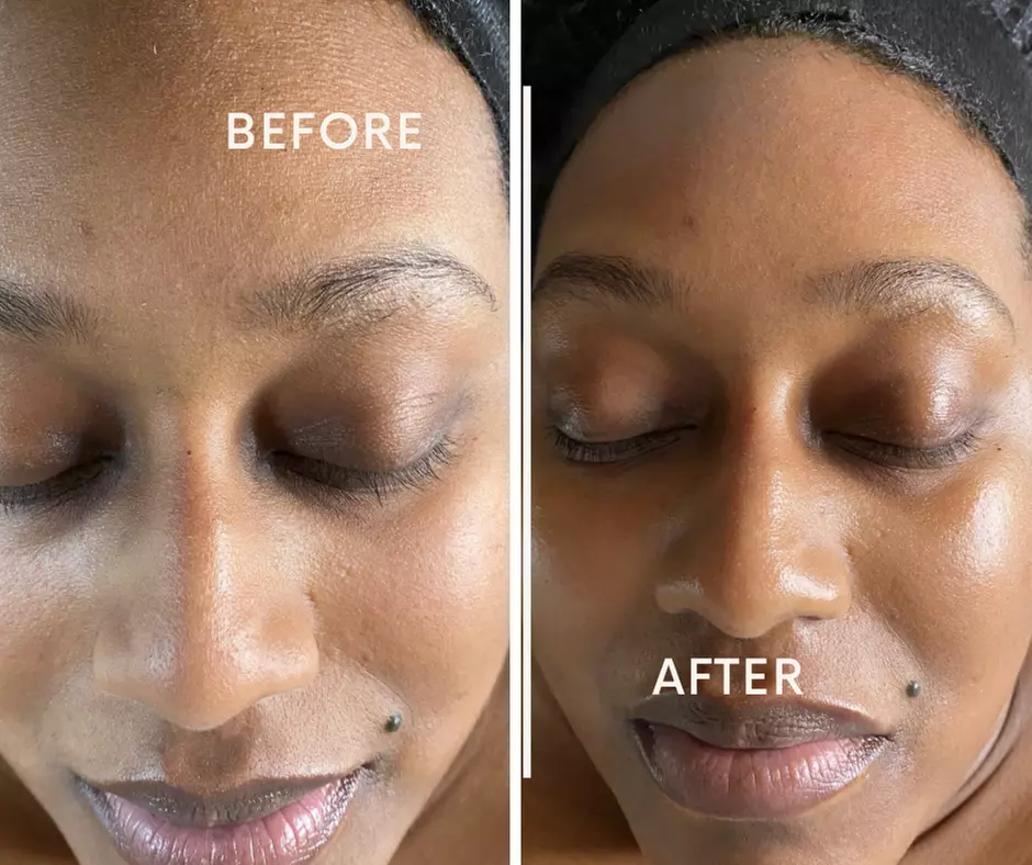 Renew Your Skin with Microdermabrasion and Enzyme Peel at Advanced Skincare By Tanya (Up to 50% Off) - Primary Image