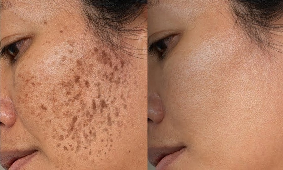 Laser Dark Spot Removal with Safe Pico Treatment