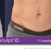 Image 8: Experience Non-Invasive Fat Reduction with TruSculpt