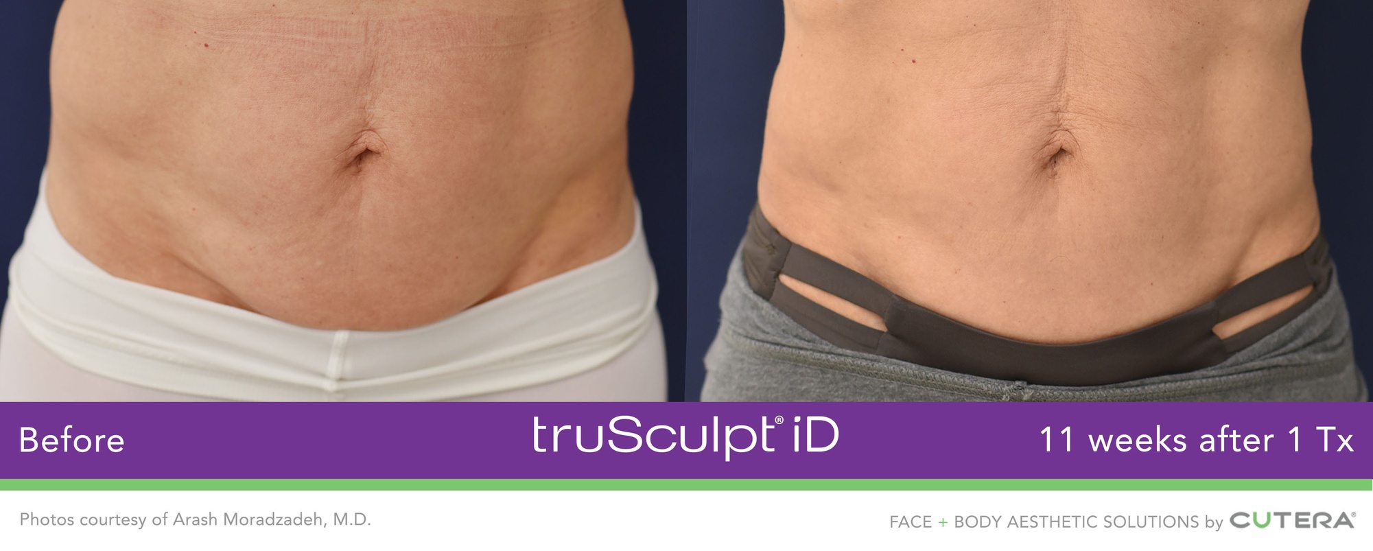 Experience Non-Invasive Fat Reduction with TruSculpt