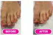 Think You Have Fungal Toenails? Get a Professional Consultation at Raymond Nash Clinic (Up to 87%) - Second Medium