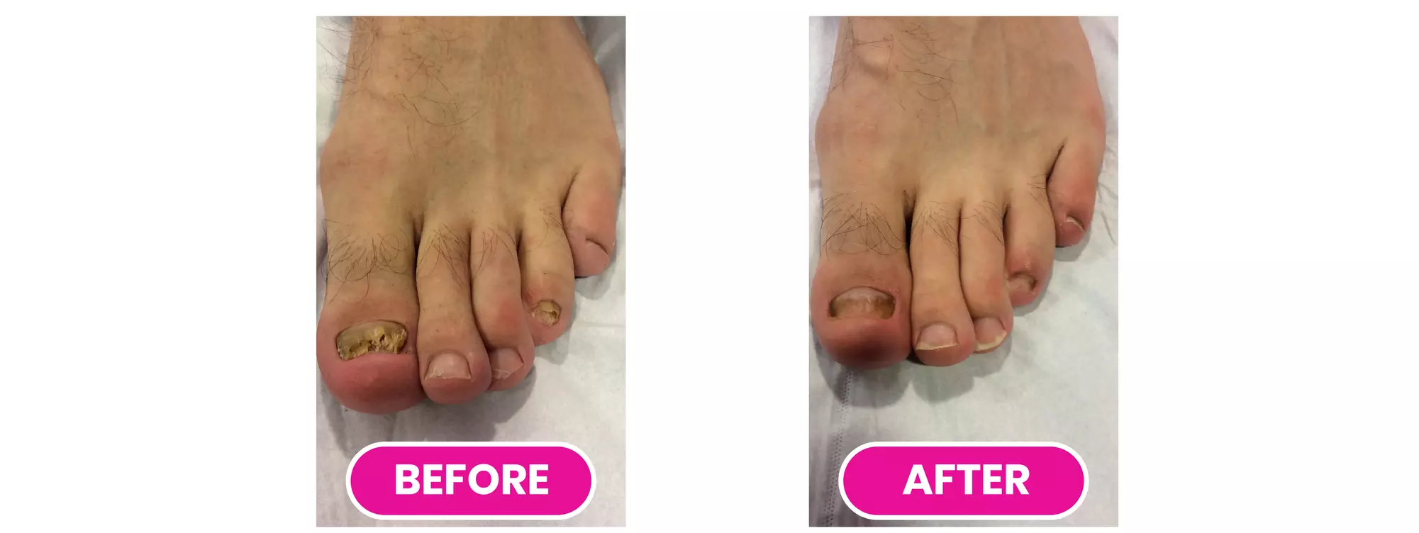 Toenail Changes? Get an Expert Diagnosis! 
(Up to 87%)