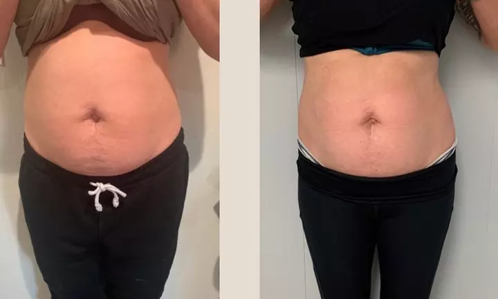Achieve your dream body with Superior Sculpting's iLipo sessions, offering up to 50% off for a slimmer, toned physique. - Primary Image