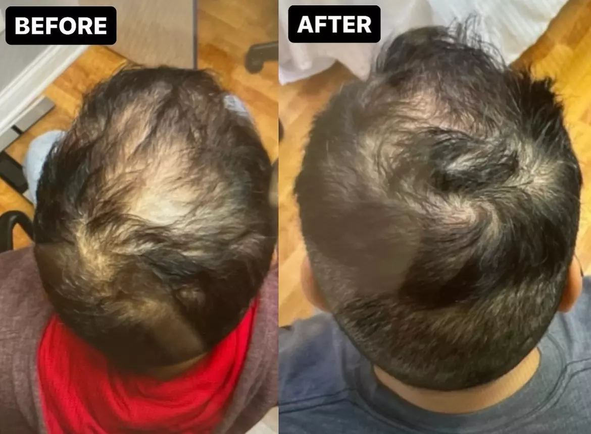 Experience Cordial Medical Spa's PRP Hair Restoration for specific areas, boosting hair density up to 50% naturally - Primary Image