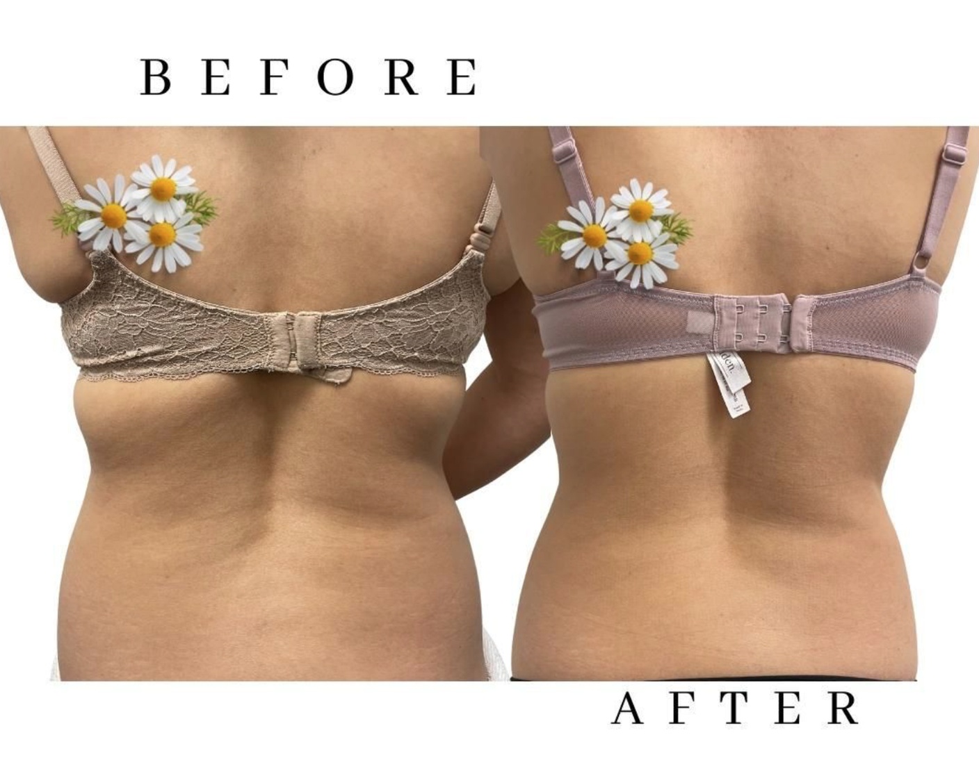 Choose From Targeted Fat Dissolving Treatment Options