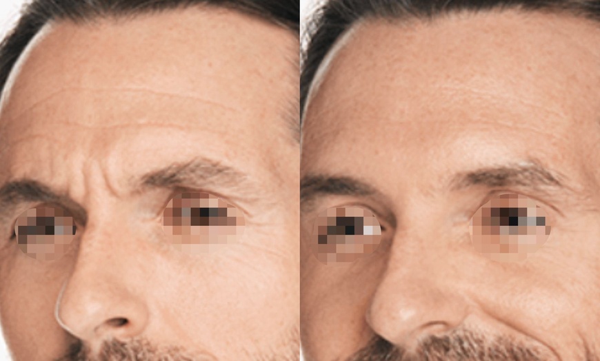 Image 3: Achieve a Smooth, Youthful Look with Xeomin: 20 Units