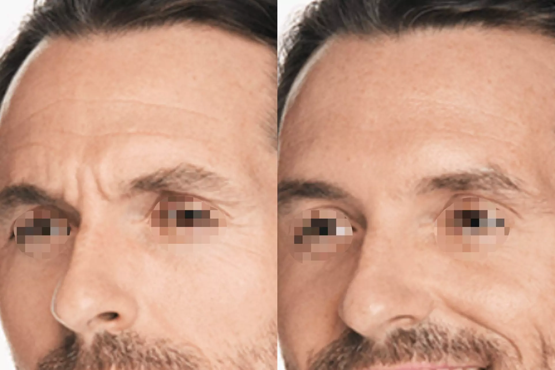 Achieve a Smooth, Youthful Look with Xeomin: 20 Units