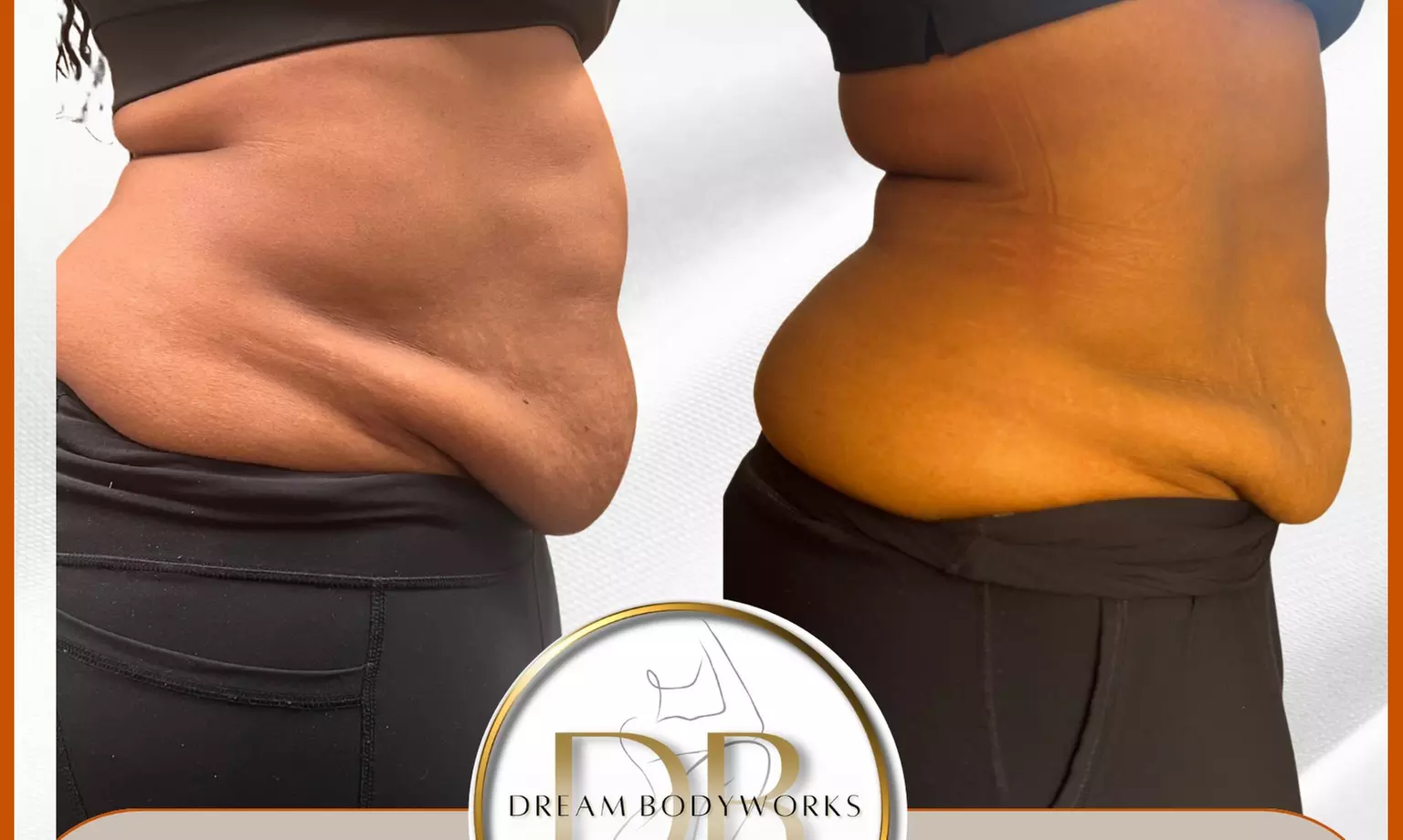 Up to 53% Off on Lymphatic Drainage Massage at Dream Bodyworks Llc