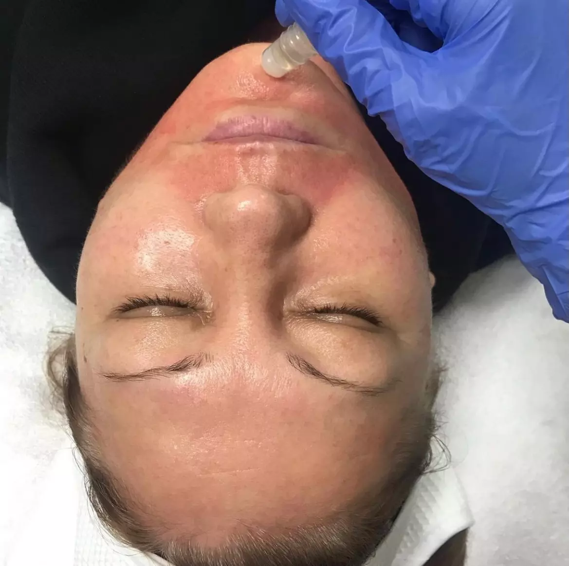 Up to 50% Off on Micro-Needling at The Beauty Lab - Second Medium