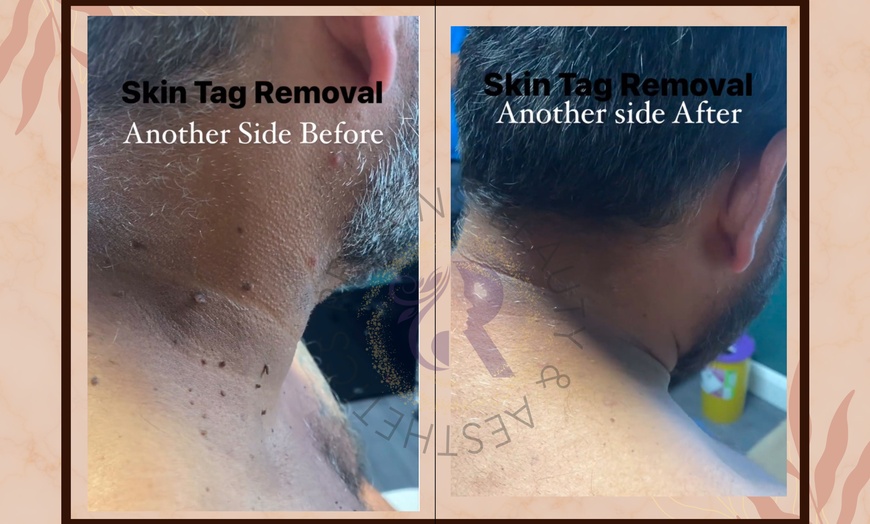 Image 4: Skin Tag Removal: 1 session w/ Wart, Papulosa/Milk Spots or Large Tag