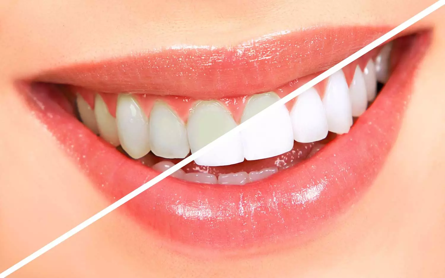 Brighten Your Smile with Teeth Whitening Options
