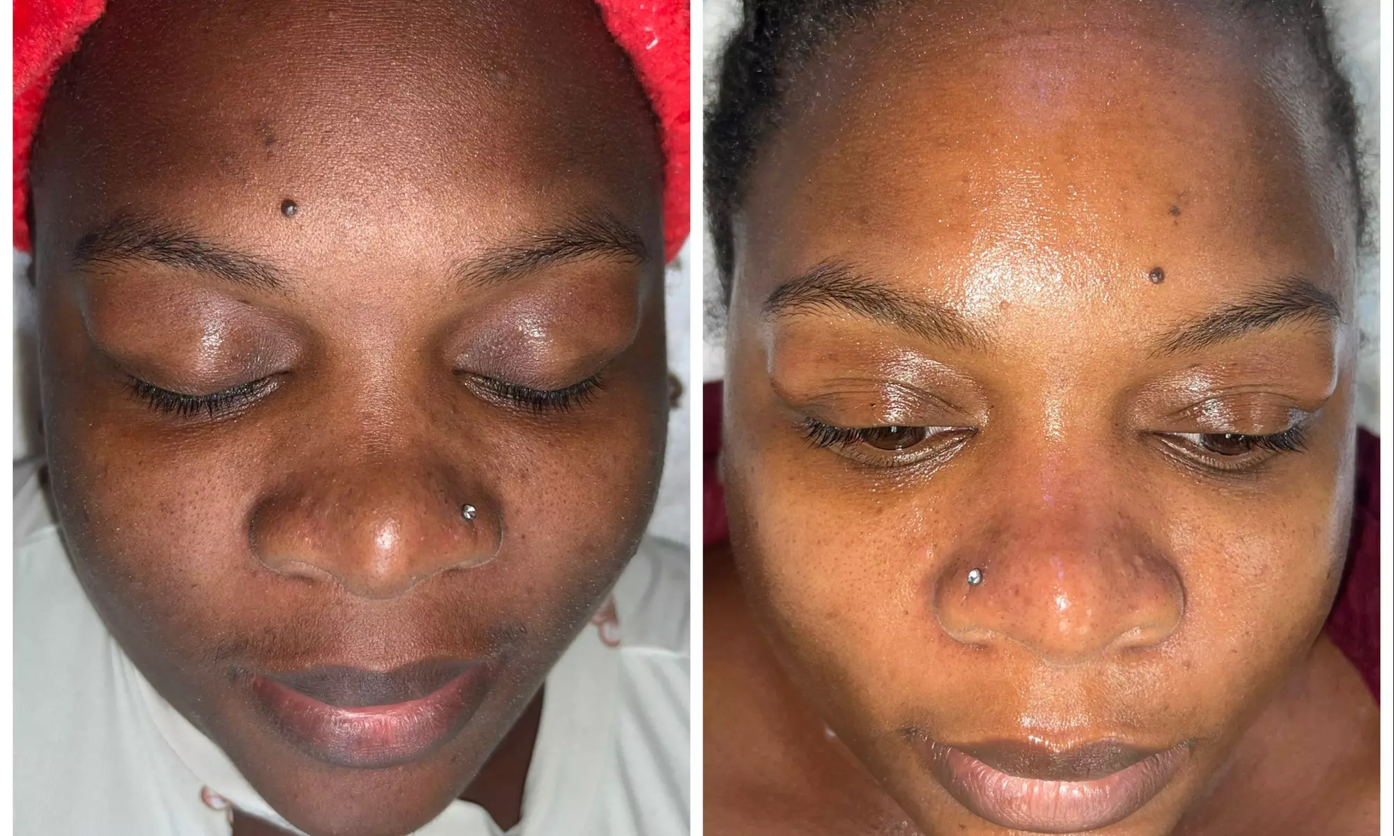 Up to 47% Off on Chemical Peel at Honey B Esthetics - Primary Image