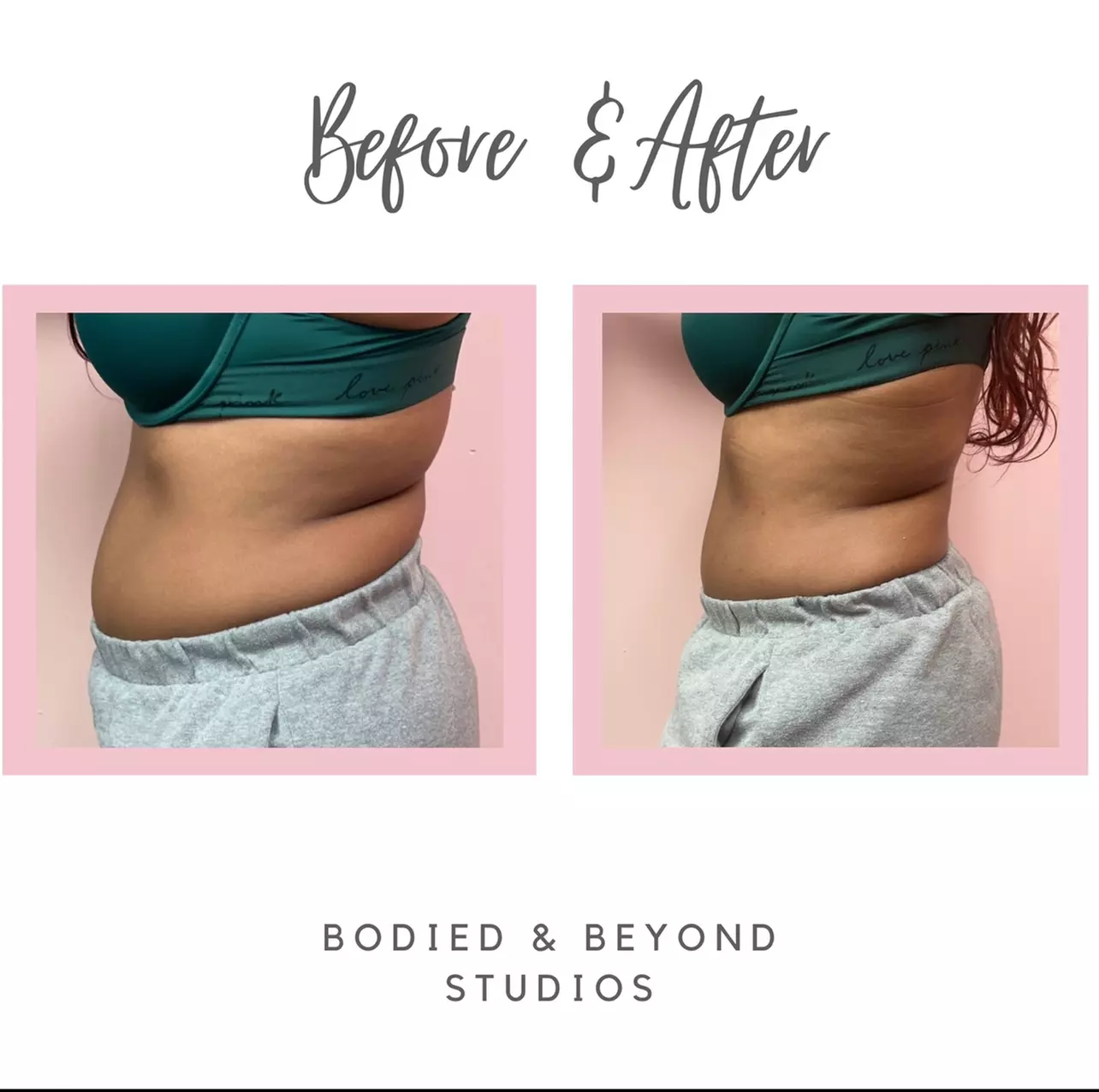 Three Laser-Lipo Sessions with Cavitation Treatments