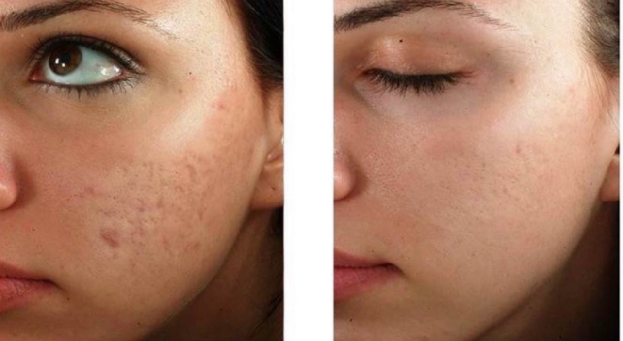 Experience rejuvenating microneedling for face and neck