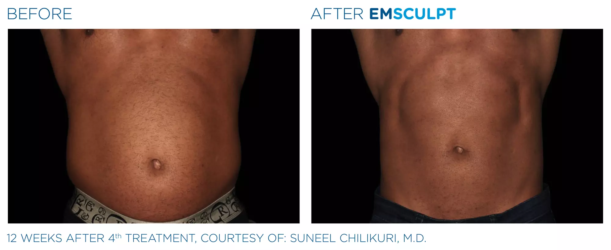 Strengthen & Tone Your Body with Two, Four, or Six Emsculpt Sessions