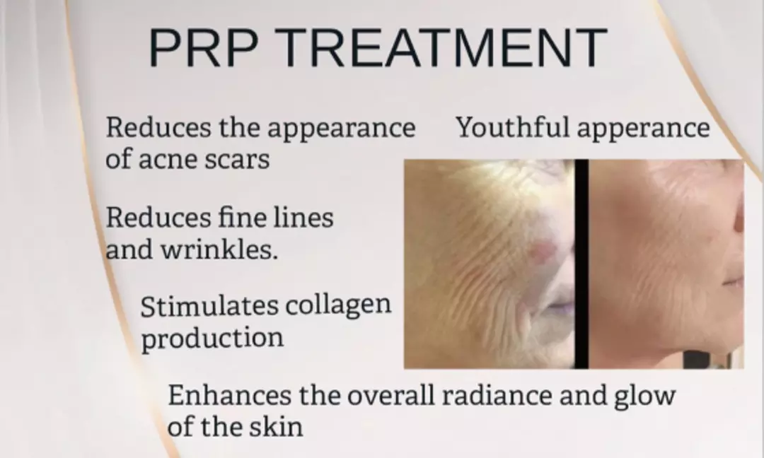 Up to 26% Off on PRP Facial at Clinic of Aesthetics - Primary Image